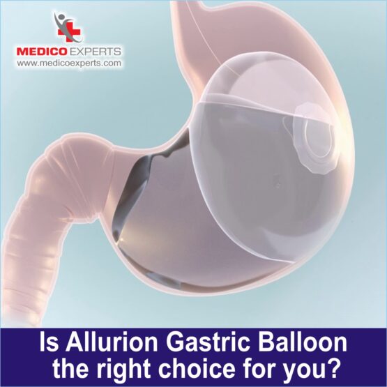 Is Allurion Gastric Balloon is the right choice for you