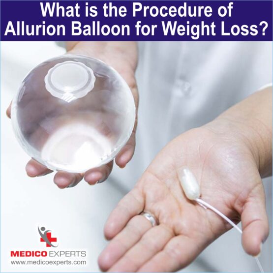 What is the procedure of Allurion Gastric Balloon for weight loss