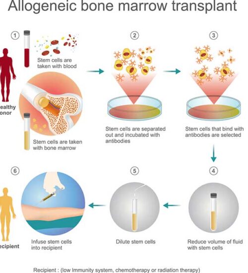 Allogeneic Peripheral Blood Stem Cell Transplant