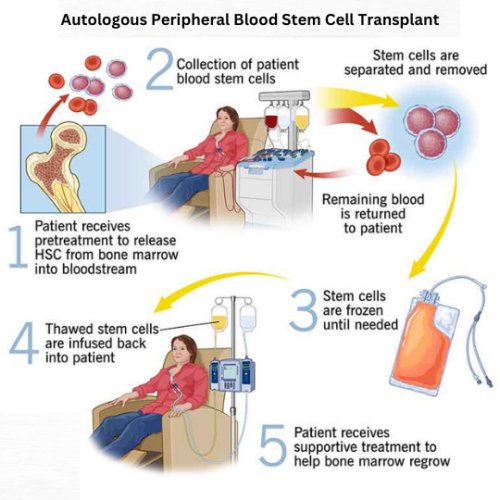 Autologous Peripheral Blood Stem Cell Transplant