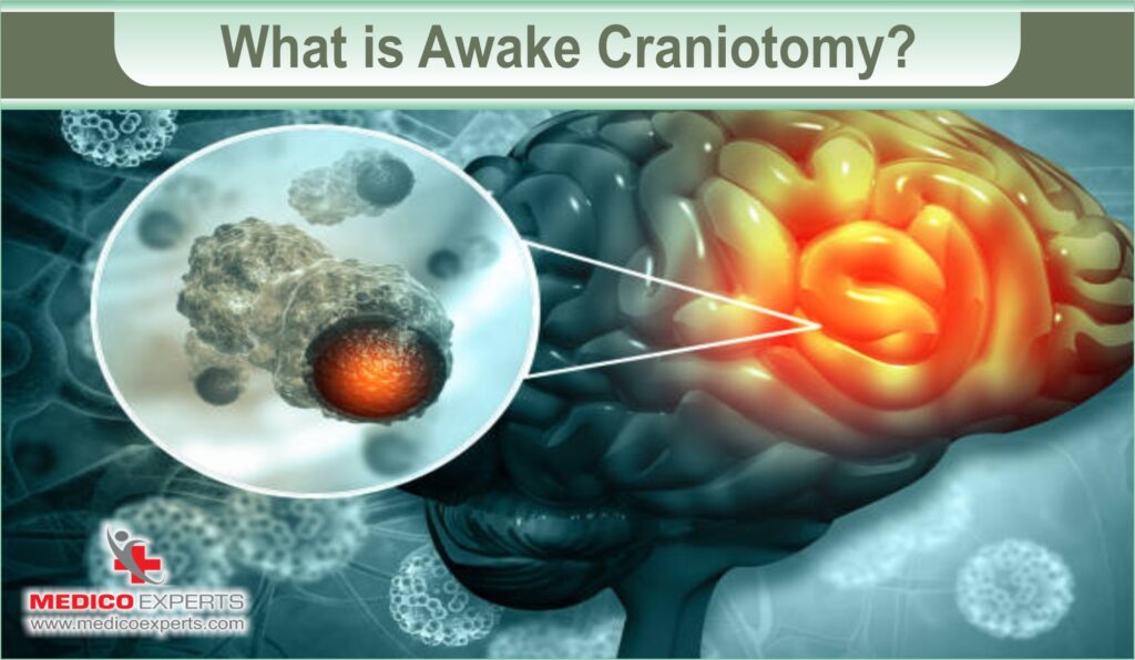 What is Awake Craniotomy?