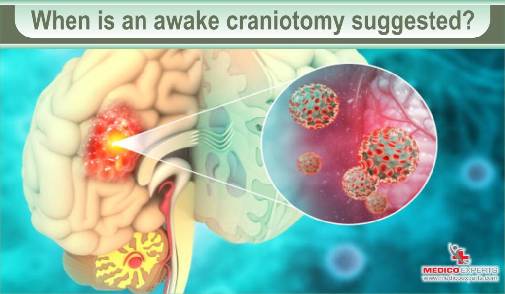 When is an awake craniotomy suggested? 