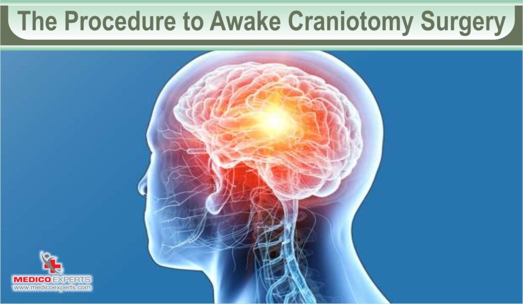 The Procedure to Awake Craniotomy Surgery