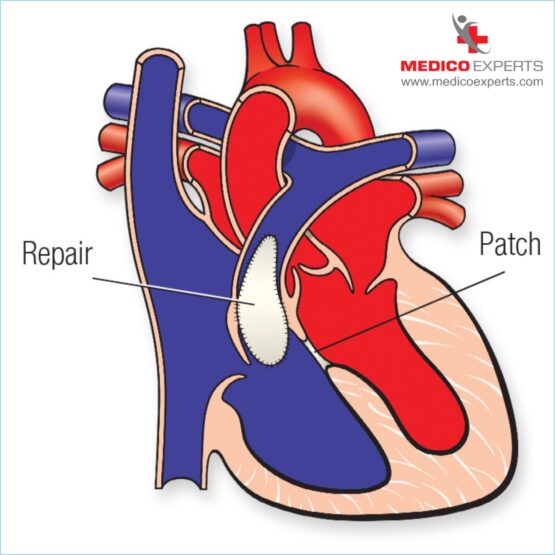 Heart Tetralogy of Fallot Treatment WEB PIX 1 Tetralogy of Fallot Treatment in Nigeria by Indian Cardiac Surgeon