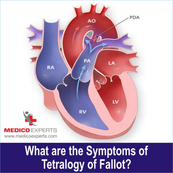 Heart Tetralogy of Fallot Treatment WEB PIX 3 (1) What are the Symptoms of Tetralogy of Fallot?