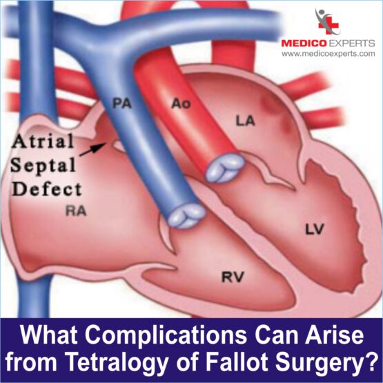 Heart Tetralogy of Fallot Treatment WEB PIX 9 What Complications Can Arise from Tetralogy of Fallot Surgery?