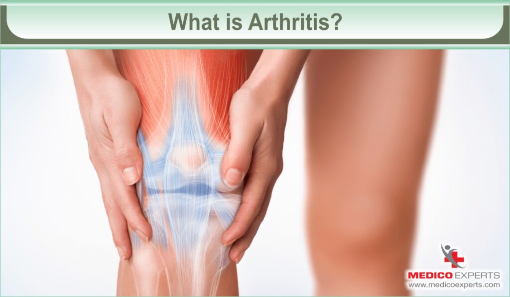 What is Arthritis?