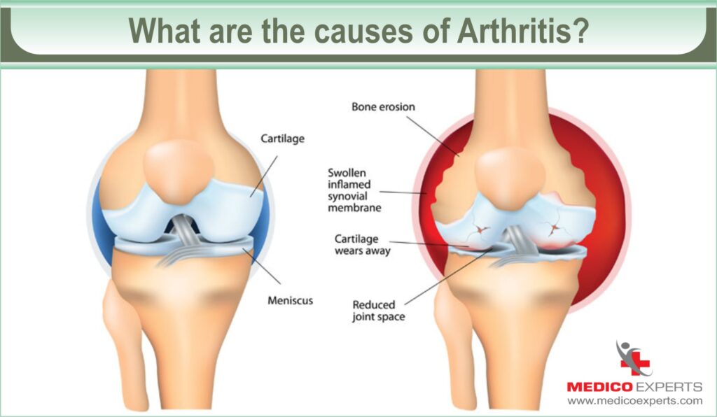 What are the causes of Arthritis?