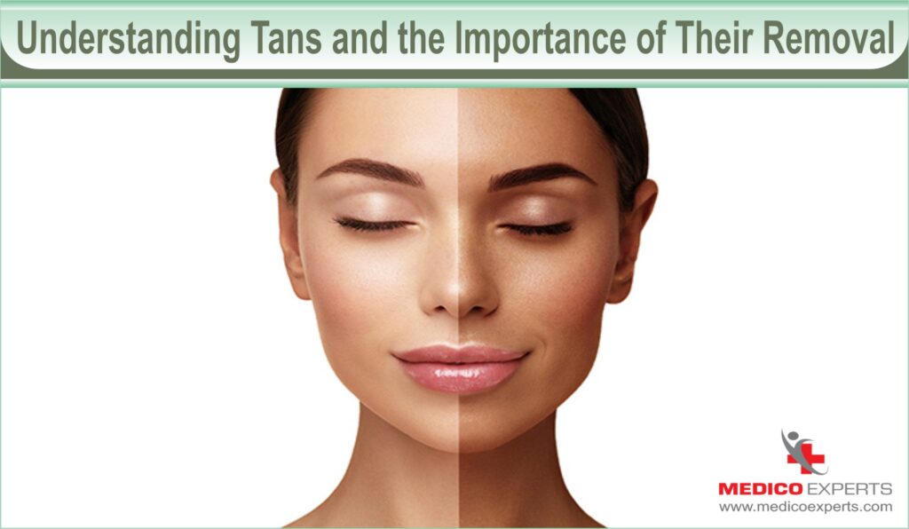 Understanding Tans and the Importance of Their Removal 