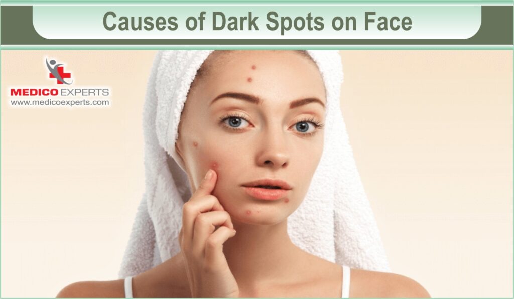 Causes of Dark Spots on Face