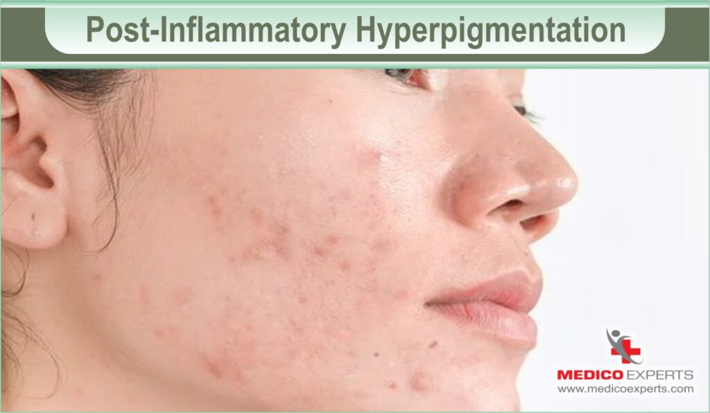 Post-Inflammatory Hyperpigmentation