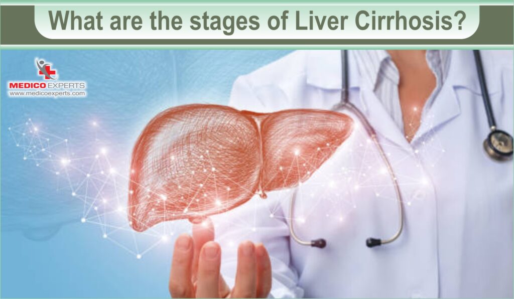 What are the stages of Liver Cirrhosis?