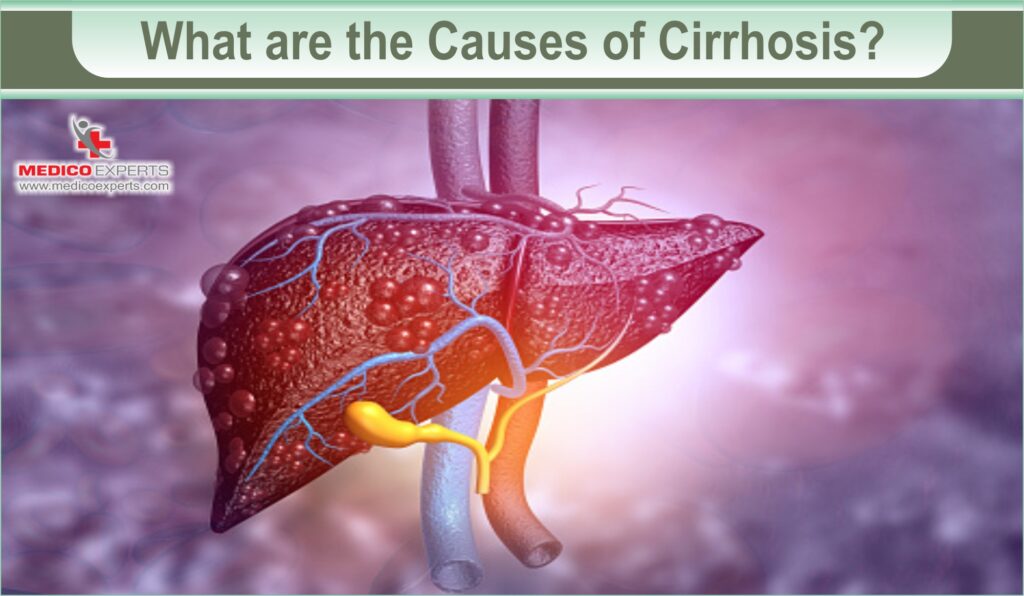 What are the Causes of Cirrhosis?