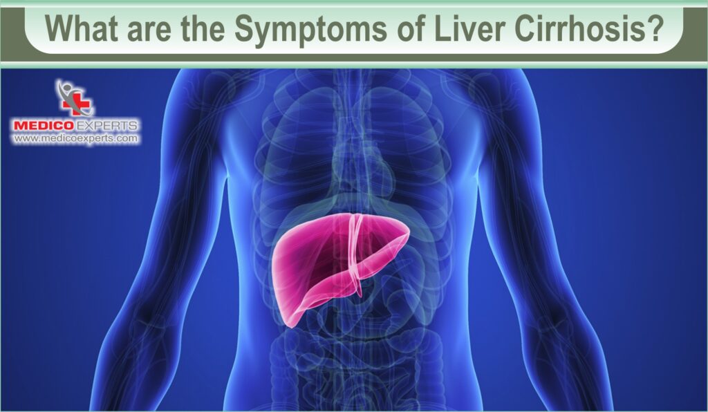 What are the Symptoms of Liver Cirrhosis?