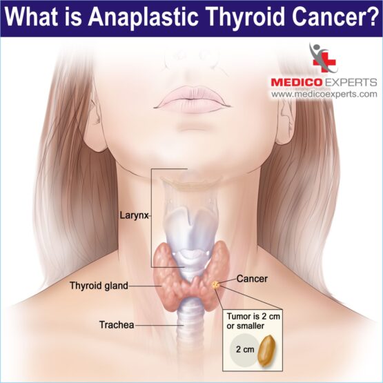 Anaplastic Thyroid PIX 4 Cancer WEB 4 What is Anaplastic Thyroid Cancer?
