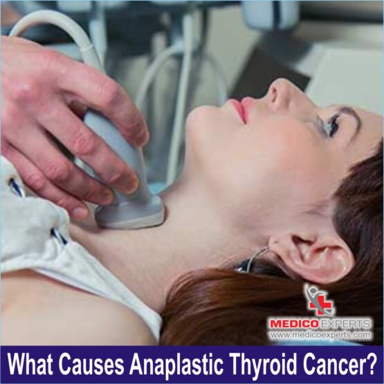 Anaplastic Thyroid PIX 5 Cancer WEB 5 What causes Anaplastic Thyroid Cancer?