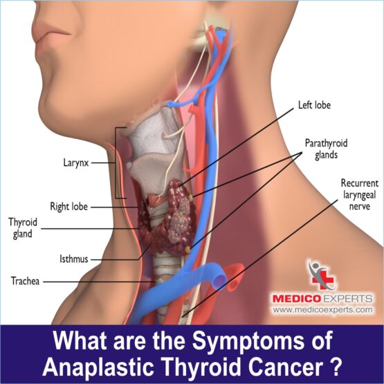 Anaplastic Thyroid PIX 7 Cancer WEB 7 What are the symptoms of Anaplastic Thyroid Cancer?