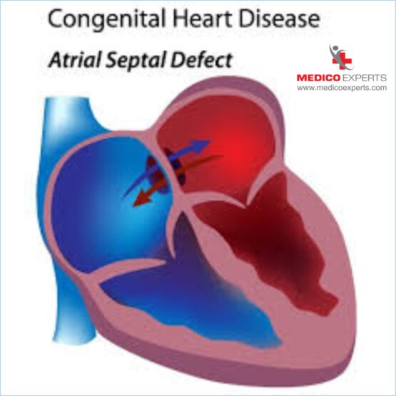 Congenital Heart Disease Atrial Septal Defect