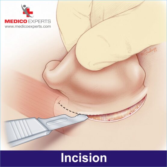 Incision