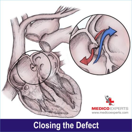 Closing the Defect