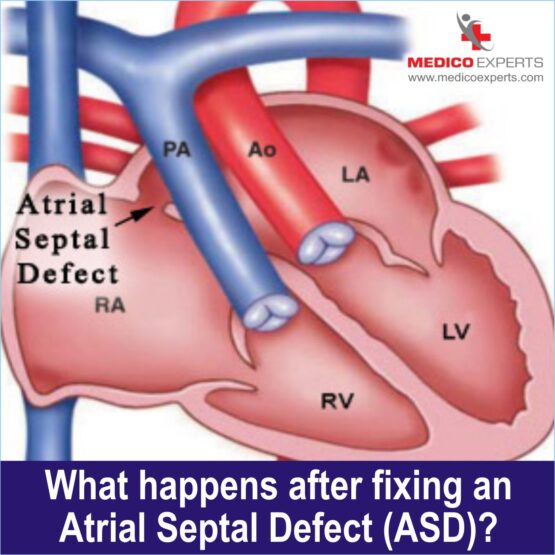 What happens after fixing an Atrial Septal Defect (ASD)?