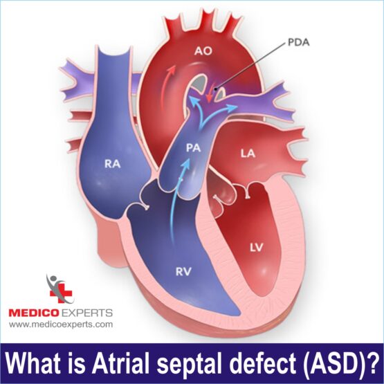 What is Atrial Septal Defect (ASD)?