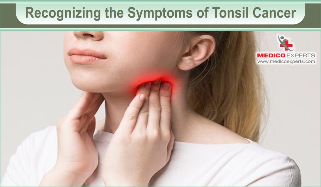 Recognizing the symptoms of Tonsil Cancer