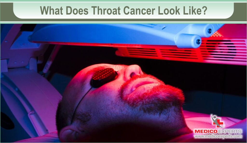 What does Throat Cancer look like?