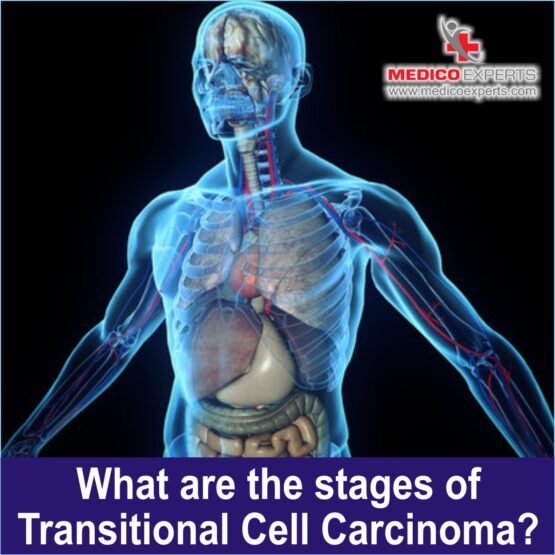 Transitional Cell Carcinoma WEB Photo 10 What are the stages of Transitional Cell Carcinoma?