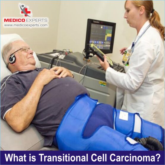 Transitional Cell Carcinoma WEB Photo 4 What is Transitional Cell Carcinoma?