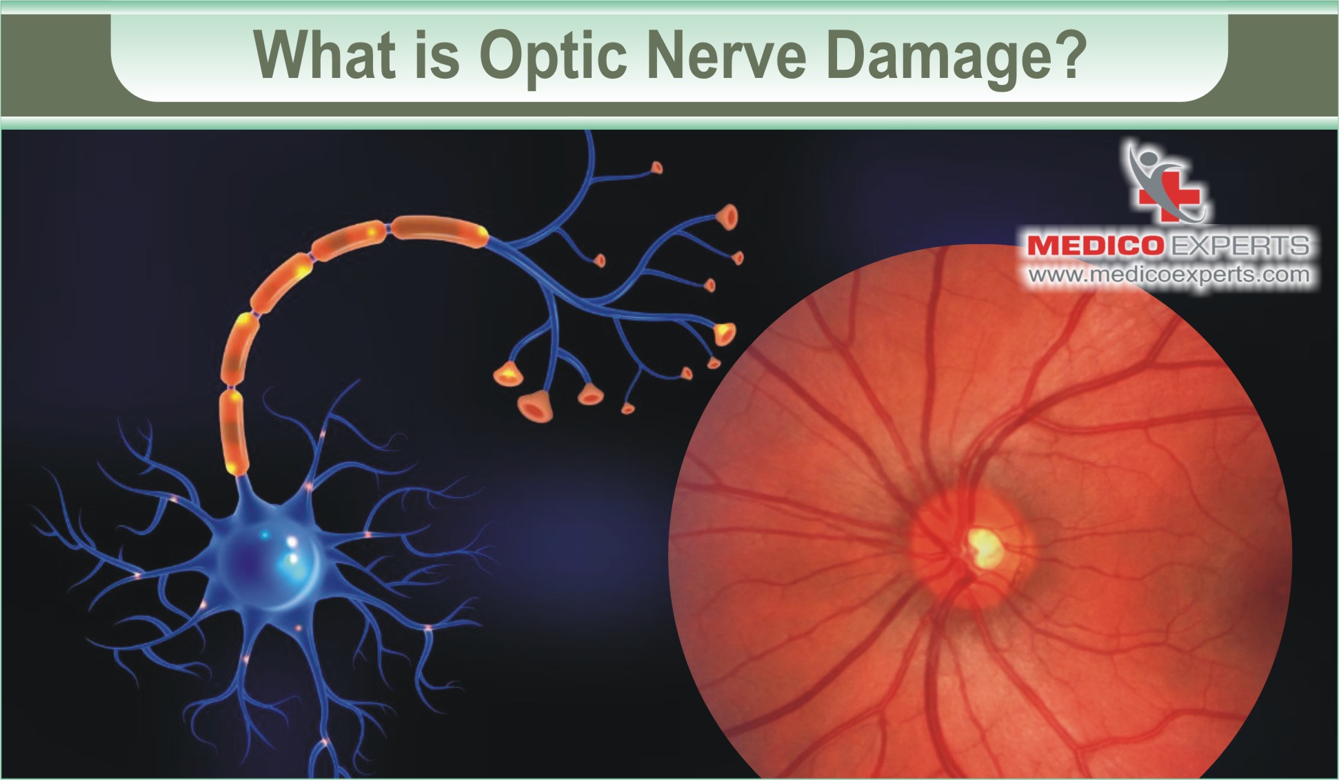 Optic Nerve Regeneration Clinical Trials 2024 Optic Nerve Regeneration: A New Frontier in Vision Restoration
