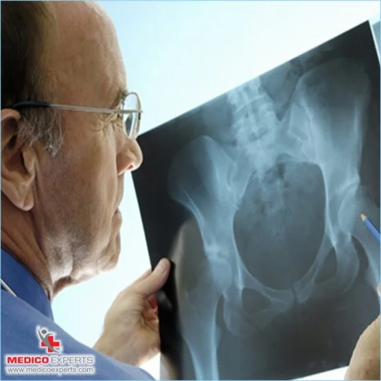 avascular necrosis treatment with stem cell therapy avascular necrosis treatment with stem cell therapy, What are the symptoms of Avascular Necrosis?