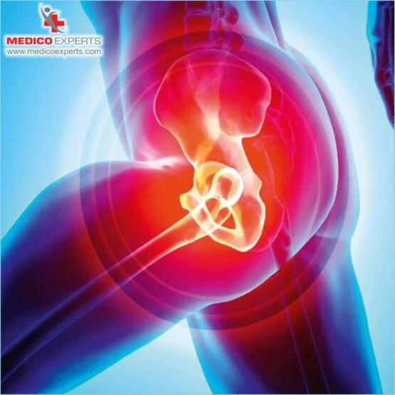 avascular necrosis treatment without surgery avascular necrosis treatment without surgery
