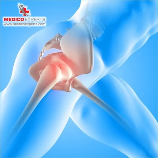 avascular necrosis treatment avascular necrosis treatment, Key Takeaways: Avascular Necrosis Treatment Without Surgery