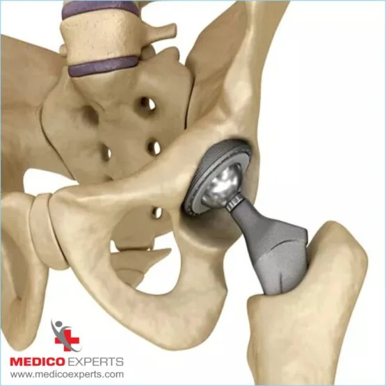 avn treatment without surgery. avn treatment without surgery,