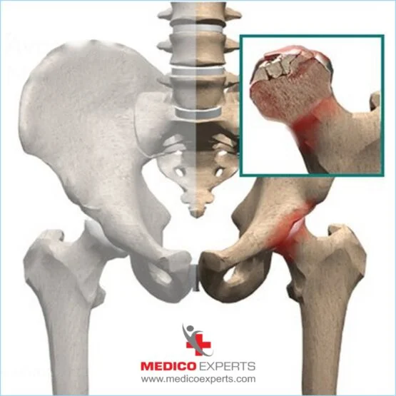 avn treatment without surgery avn treatment without surgery, In simple terms, avascular necrosis (AVN) is a disease in which your bone tissues die due to a lack of blood supply.