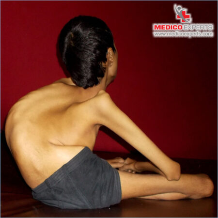 Oculopharyngeal Muscular Dystrophy (OMD)