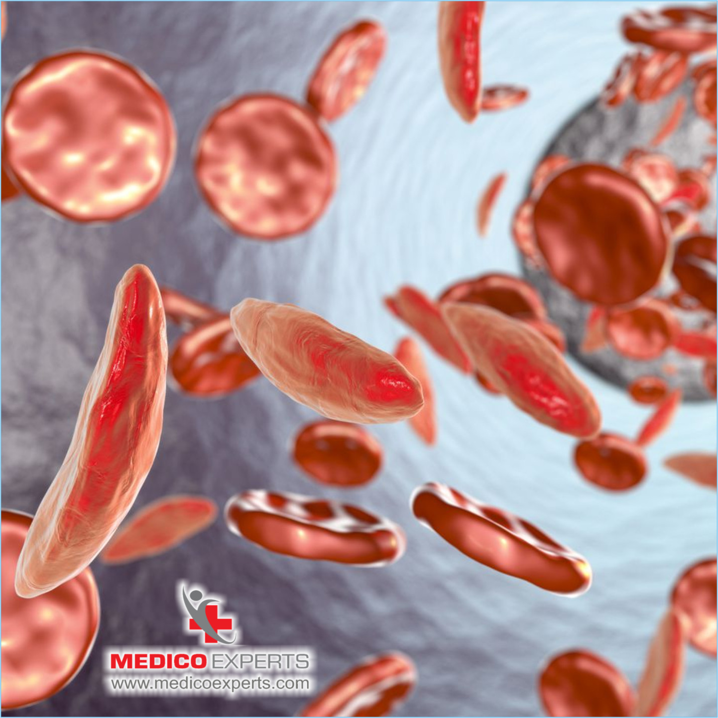 What are the Causes of Multiple Myeloma?