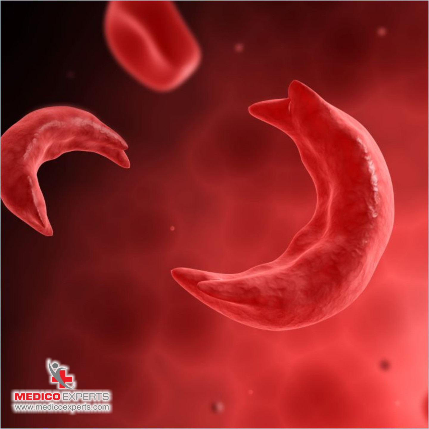 What are the Early Symptoms of Multiple Myeloma?