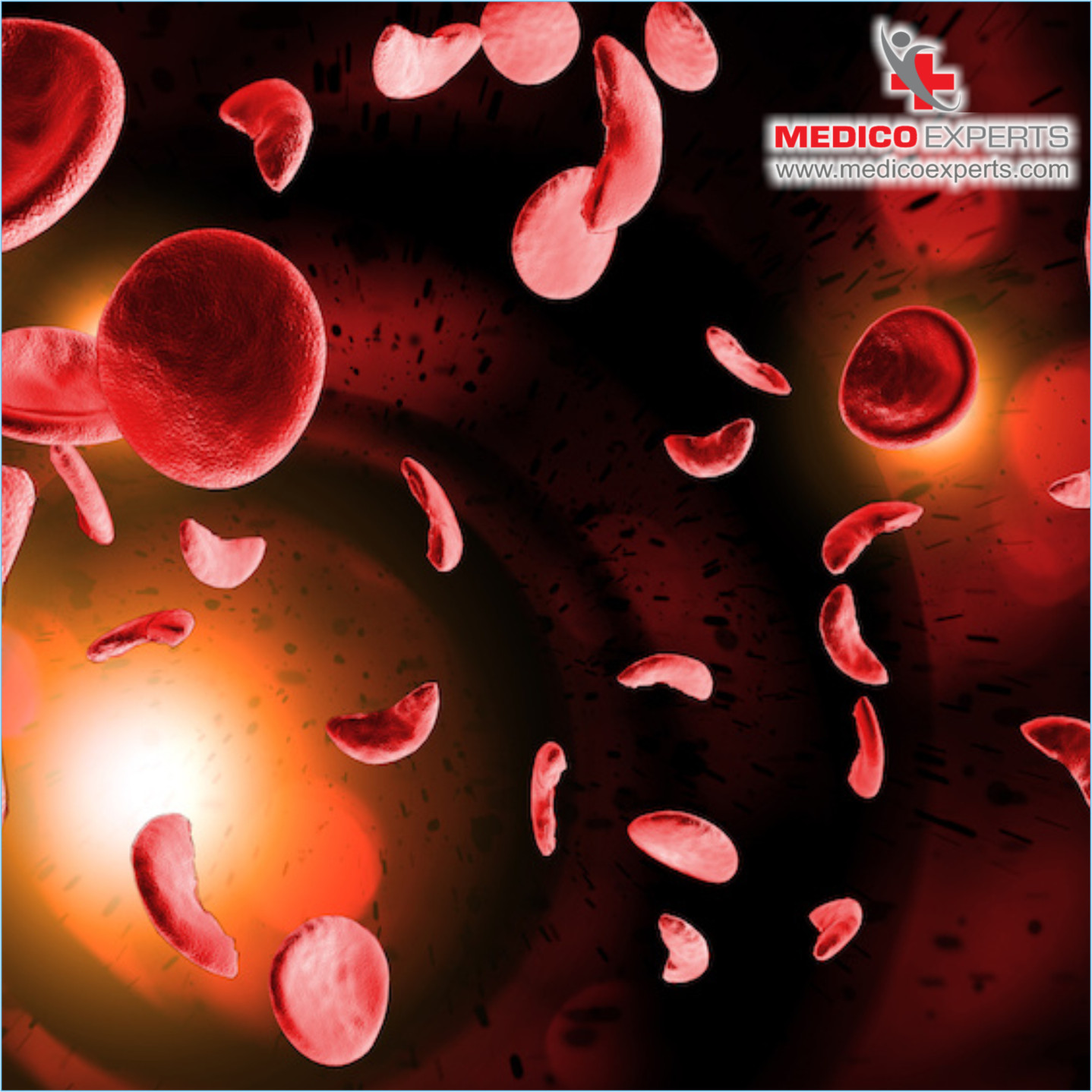 What are the Stages of Multiple Myeloma?