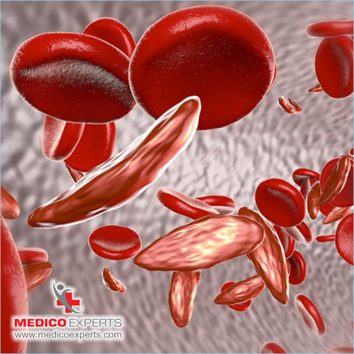 What are the Tests for Multiple Myeloma