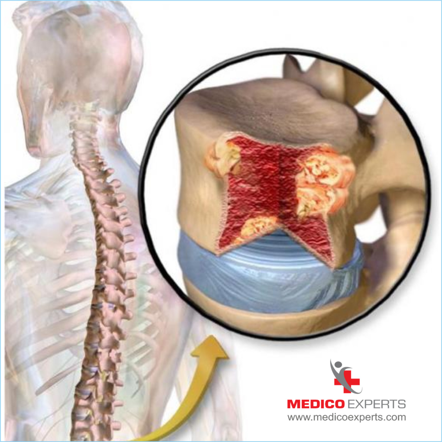 What is Multiple Myeloma?