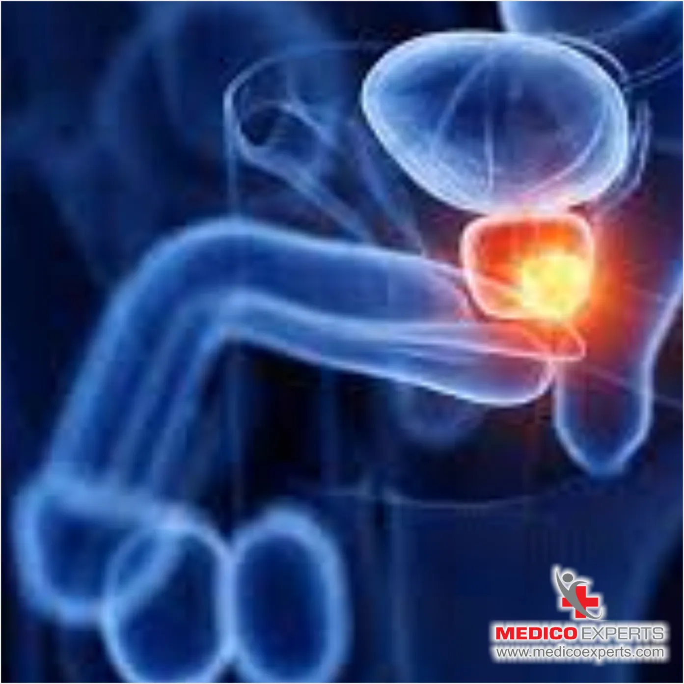 How Effective is Proton Beam Therapy_3_11zon How Effective is Proton Beam Therapy for Prostate Cancer?