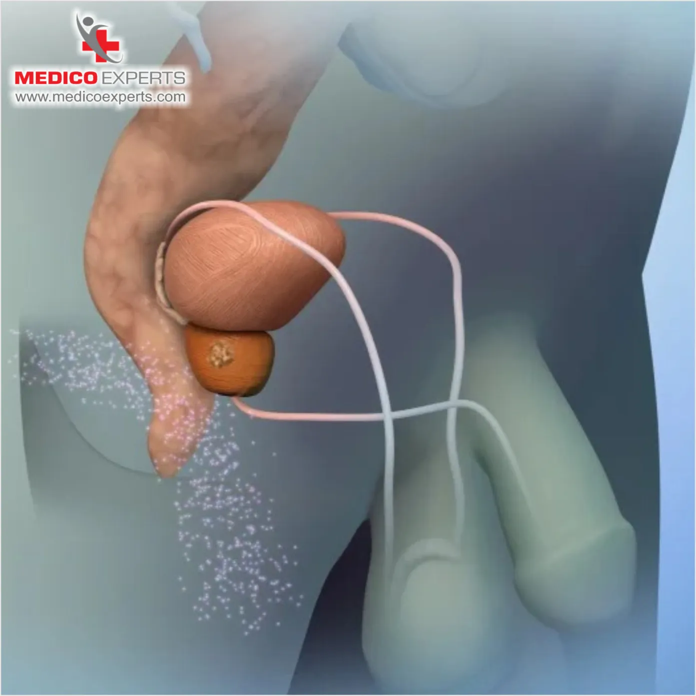 What is Proton Beam Therapy for Prostate Cancer_8_11zon What is Proton Beam Therapy for Prostate Cancer?