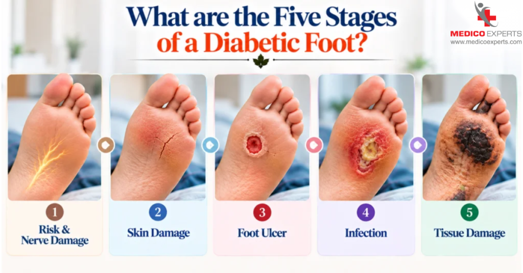Diabetic Foot Signs and Symptoms: Warning Signs, Stages, and When to Seek Help 13 What are the Five Stages of a Diabetic Foot?